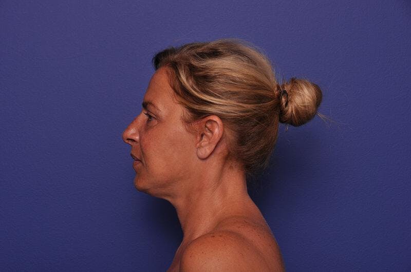 Upper Blepharoplasty Before & After Gallery - Patient 211514 - Image 4