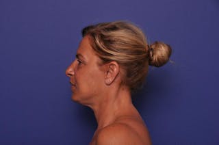 Upper Blepharoplasty Before & After Gallery - Patient 211514 - Image 4