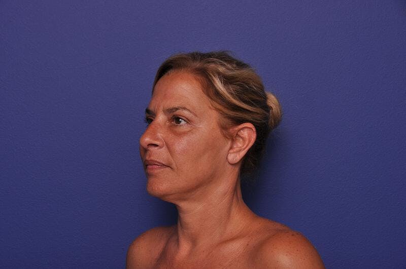 Upper Blepharoplasty Before & After Gallery - Patient 211514 - Image 6