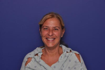 Upper Blepharoplasty Before & After Gallery - Patient 211514 - Image 1