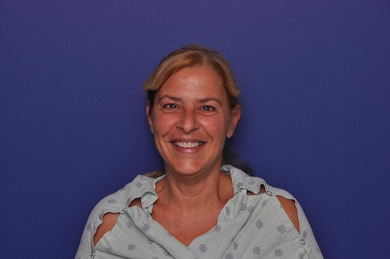 Upper Blepharoplasty Before & After Gallery - Patient 211514 - Image 1