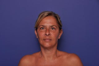 Upper Blepharoplasty Before & After Gallery - Patient 211514 - Image 2