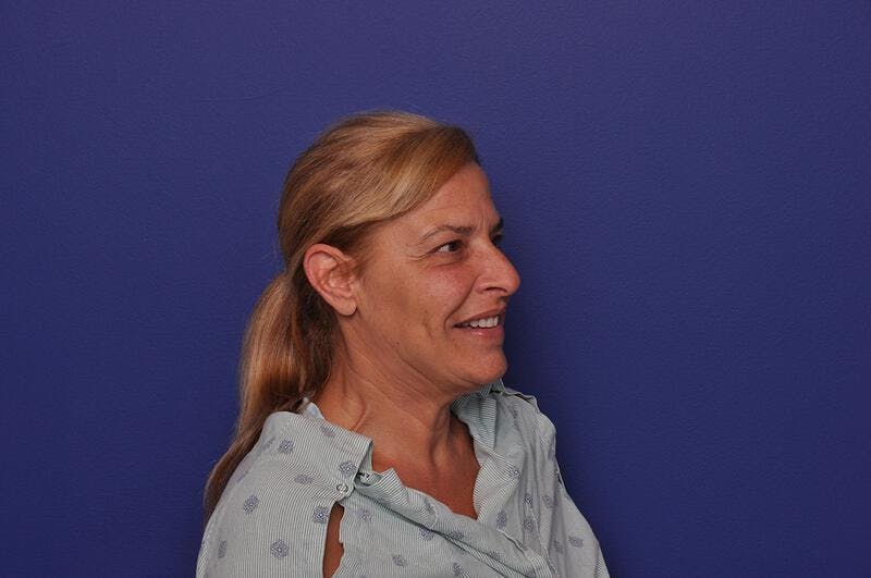 Upper Blepharoplasty Before & After Gallery - Patient 211514 - Image 7