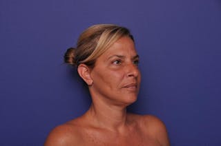 Upper Blepharoplasty Before & After Gallery - Patient 211514 - Image 8