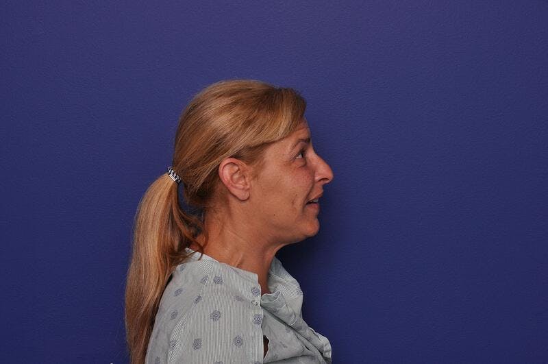 Upper Blepharoplasty Before & After Gallery - Patient 211514 - Image 9
