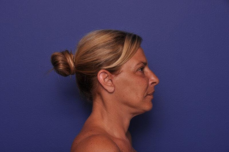Upper Blepharoplasty Before & After Gallery - Patient 211514 - Image 10