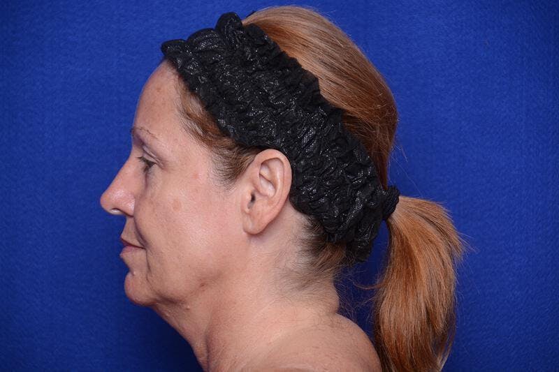 Upper Blepharoplasty Before & After Gallery - Patient 716973 - Image 3