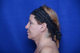 Upper Blepharoplasty Before & After Gallery - Patient 716973 - Image 4