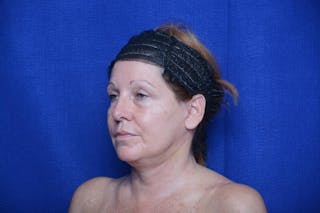 Upper Blepharoplasty Before & After Gallery - Patient 716973 - Image 6