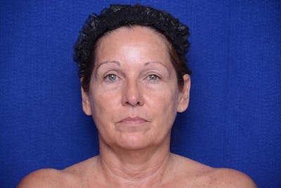Upper Blepharoplasty Before & After Gallery - Patient 716973 - Image 1