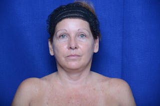 Upper Blepharoplasty Before & After Gallery - Patient 716973 - Image 2