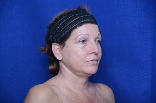 Upper Blepharoplasty Before & After Gallery - Patient 716973 - Image 8