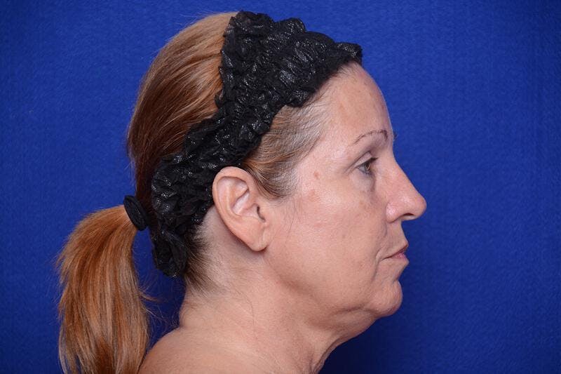 Upper Blepharoplasty Before & After Gallery - Patient 716973 - Image 9