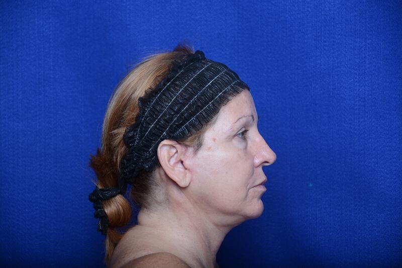 Upper Blepharoplasty Before & After Gallery - Patient 716973 - Image 10