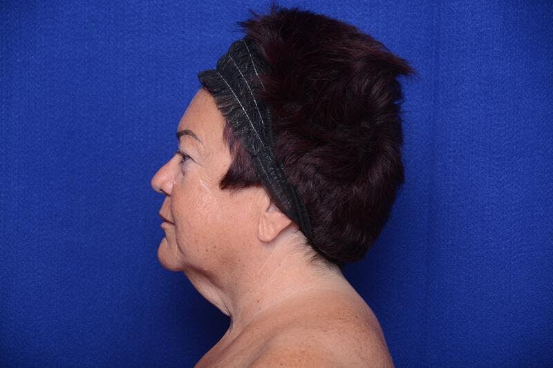 Upper Blepharoplasty Before & After Gallery - Patient 387541 - Image 3