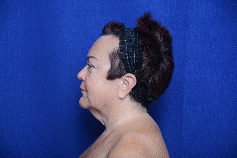 Upper Blepharoplasty Before & After Gallery - Patient 387541 - Image 4