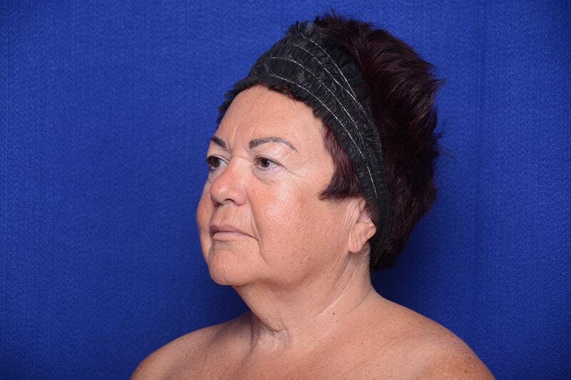 Upper Blepharoplasty Before & After Gallery - Patient 387541 - Image 5