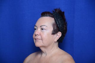 Upper Blepharoplasty Before & After Gallery - Patient 387541 - Image 6