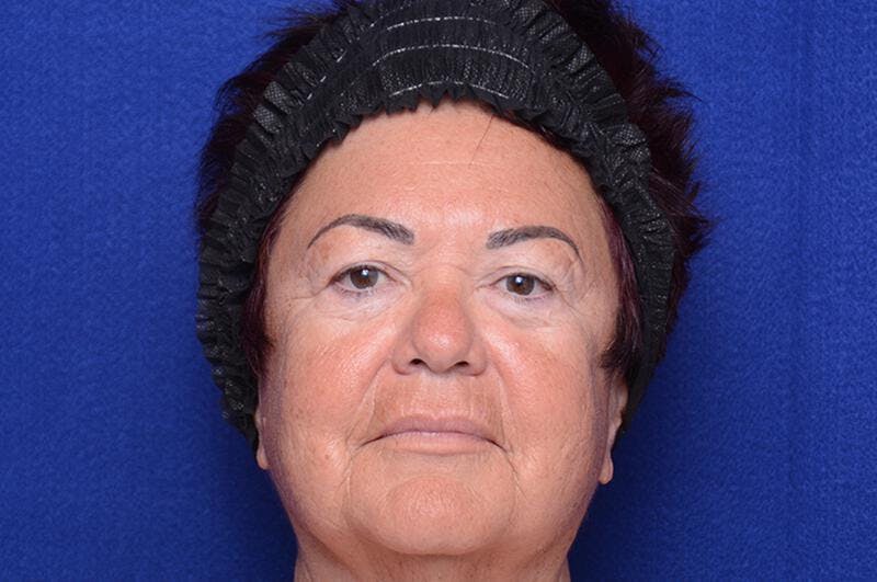 Upper Blepharoplasty Before & After Gallery - Patient 387541 - Image 1