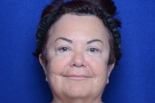 Upper Blepharoplasty Before & After Gallery - Patient 387541 - Image 2