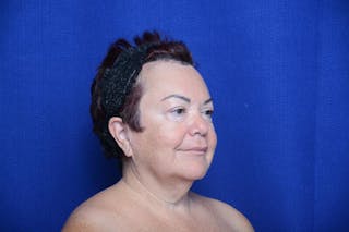 Upper Blepharoplasty Before & After Gallery - Patient 387541 - Image 8