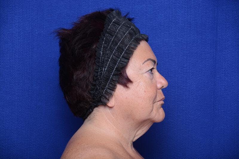 Upper Blepharoplasty Before & After Gallery - Patient 387541 - Image 9