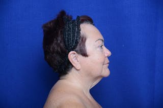 Upper Blepharoplasty Before & After Gallery - Patient 387541 - Image 10