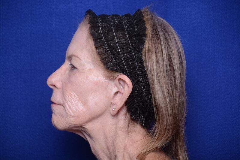 Upper Blepharoplasty Before & After Gallery - Patient 331069 - Image 3