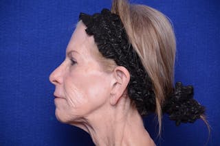 Upper Blepharoplasty Before & After Gallery - Patient 331069 - Image 4