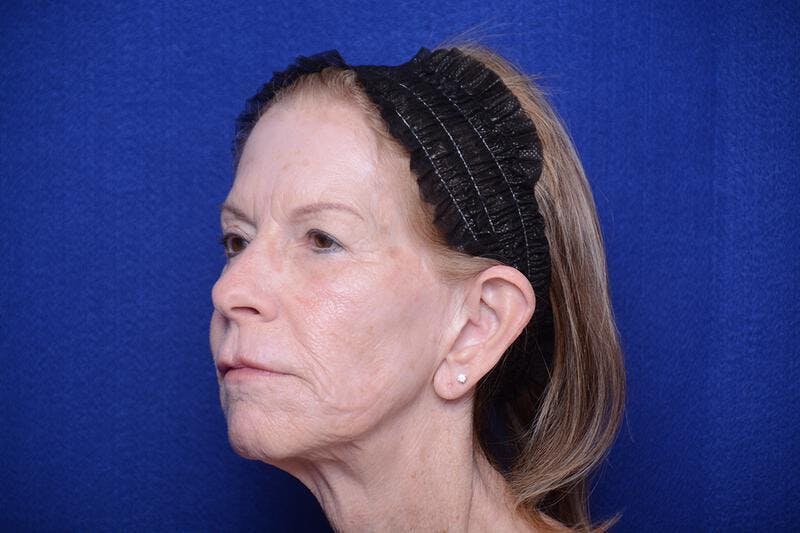 Upper Blepharoplasty Before & After Gallery - Patient 331069 - Image 5