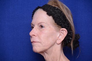 Upper Blepharoplasty Before & After Gallery - Patient 331069 - Image 6