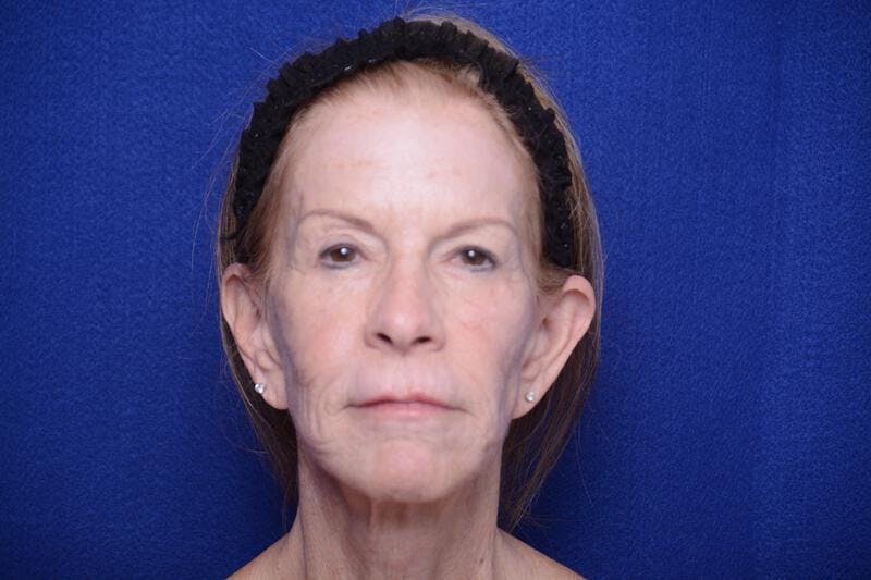 Upper Blepharoplasty Before & After Gallery - Patient 331069 - Image 1