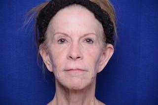 Upper Blepharoplasty Before & After Gallery - Patient 331069 - Image 2