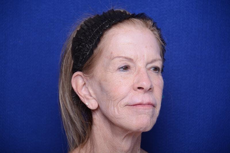 Upper Blepharoplasty Before & After Gallery - Patient 331069 - Image 7