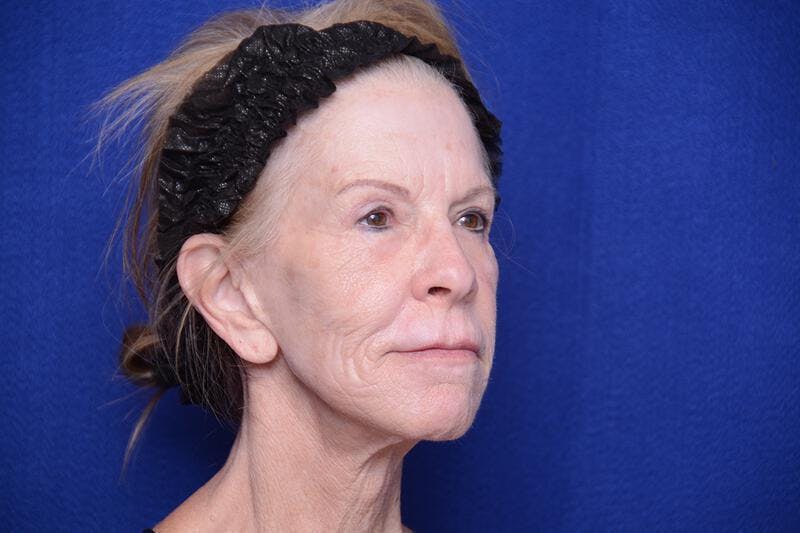 Upper Blepharoplasty Before & After Gallery - Patient 331069 - Image 8