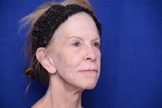 Upper Blepharoplasty Before & After Gallery - Patient 331069 - Image 8
