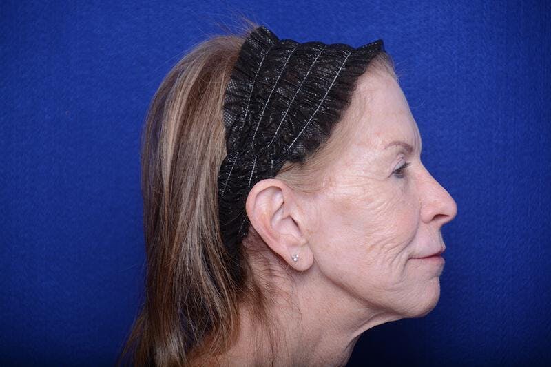 Upper Blepharoplasty Before & After Gallery - Patient 331069 - Image 9