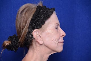 Upper Blepharoplasty Before & After Gallery - Patient 331069 - Image 10