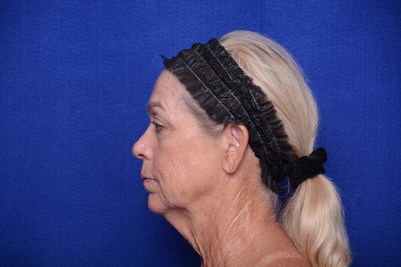 Upper Blepharoplasty Before & After Gallery - Patient 394081 - Image 3