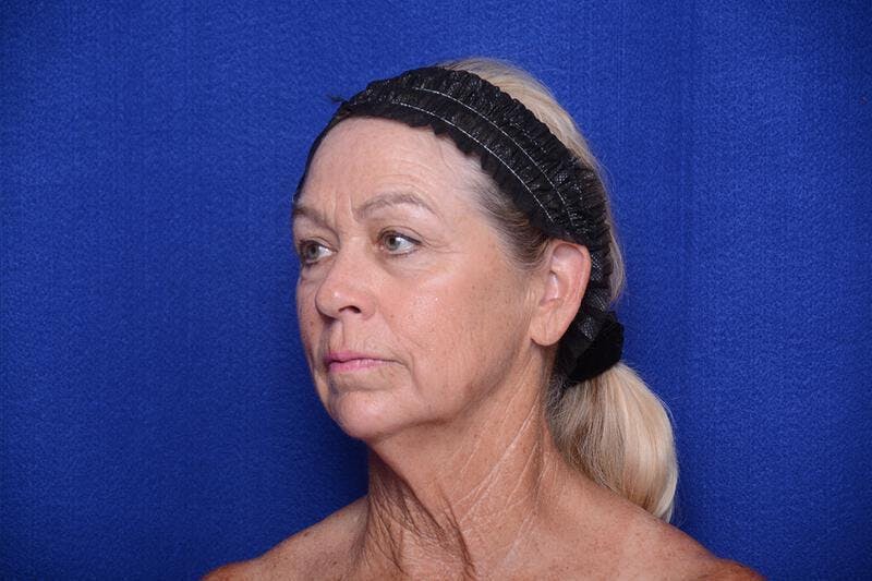 Upper Blepharoplasty Before & After Gallery - Patient 394081 - Image 5