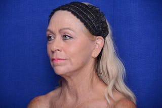 Upper Blepharoplasty Before & After Gallery - Patient 394081 - Image 6