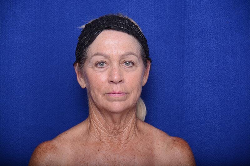 Upper Blepharoplasty Before & After Gallery - Patient 394081 - Image 1