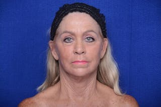 Upper Blepharoplasty Before & After Gallery - Patient 394081 - Image 2