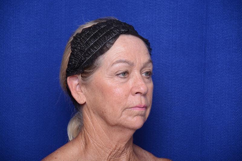 Upper Blepharoplasty Before & After Gallery - Patient 394081 - Image 7