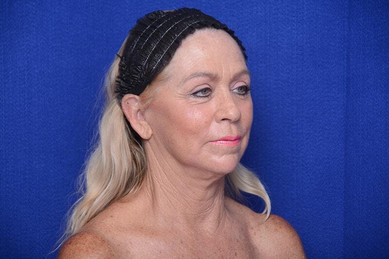 Upper Blepharoplasty Before & After Gallery - Patient 394081 - Image 8