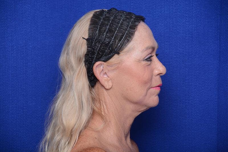Upper Blepharoplasty Before & After Gallery - Patient 394081 - Image 9