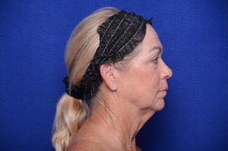 Upper Blepharoplasty Before & After Gallery - Patient 394081 - Image 10