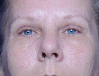 Upper Blepharoplasty Before & After Gallery - Patient 116612 - Image 1