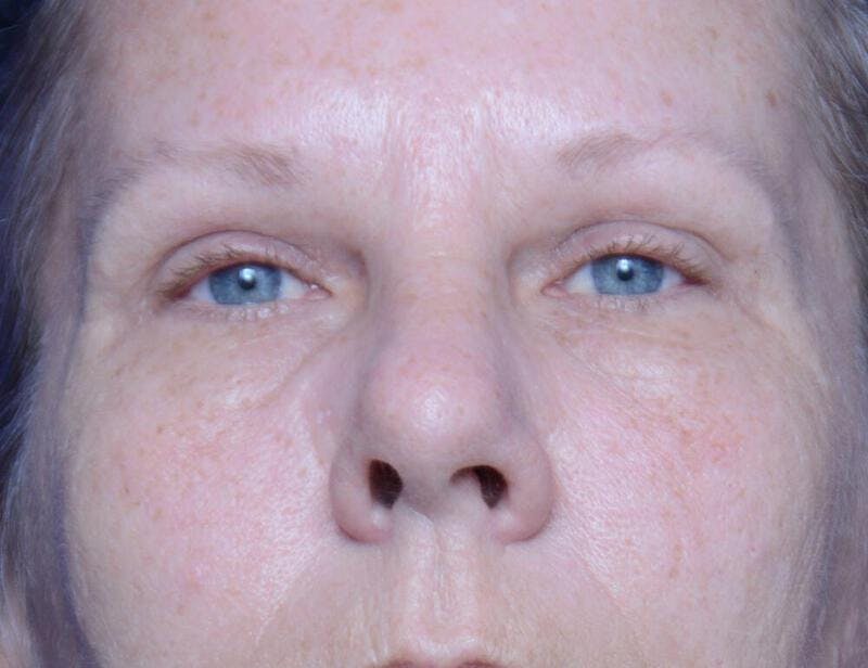 Upper Blepharoplasty Before & After Gallery - Patient 116612 - Image 1