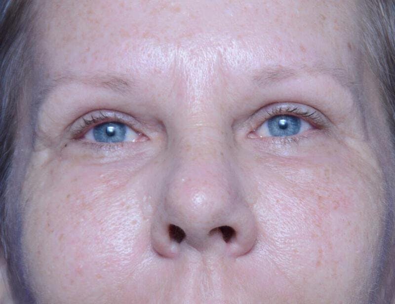 Upper Blepharoplasty Before & After Gallery - Patient 116612 - Image 2